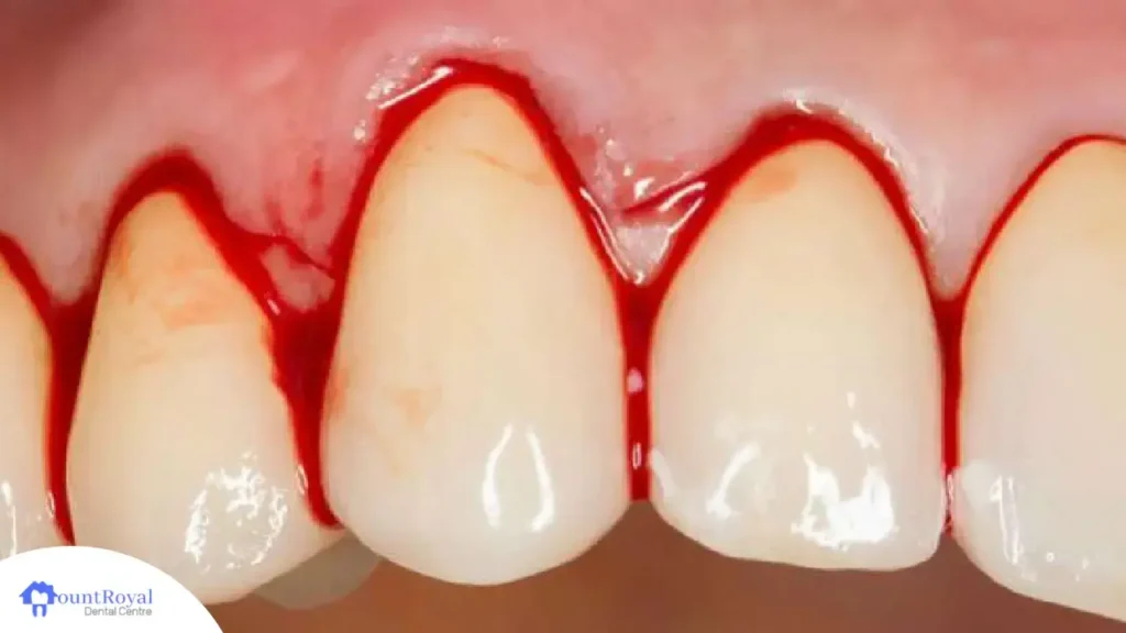 Why Are My Gums Bleeding