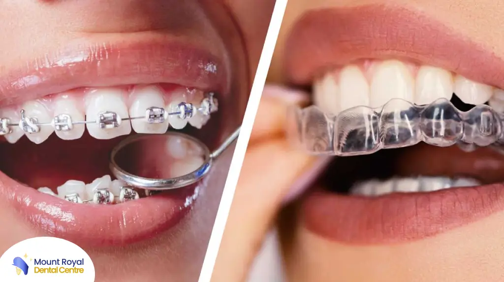 clear Aligners vs Traditional Braces mountroyaldentalcentre