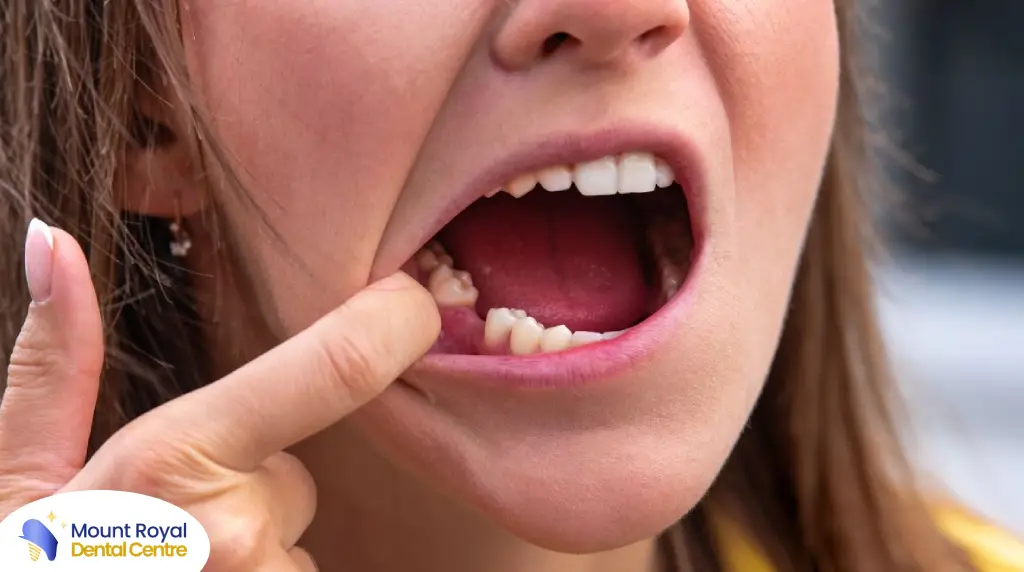 5 Benefits of Replacing Missing Teeth Early
