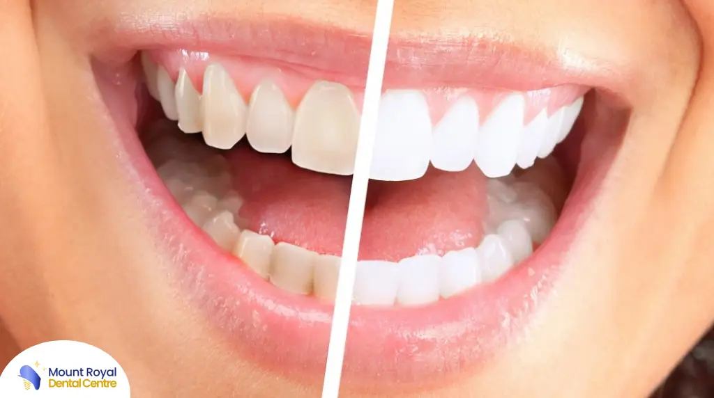 What Happens During a Professional Dental Cleaning