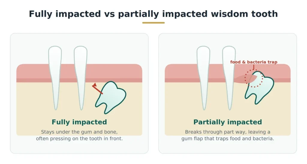 fully impacted vs partially impacted wisdom tooth